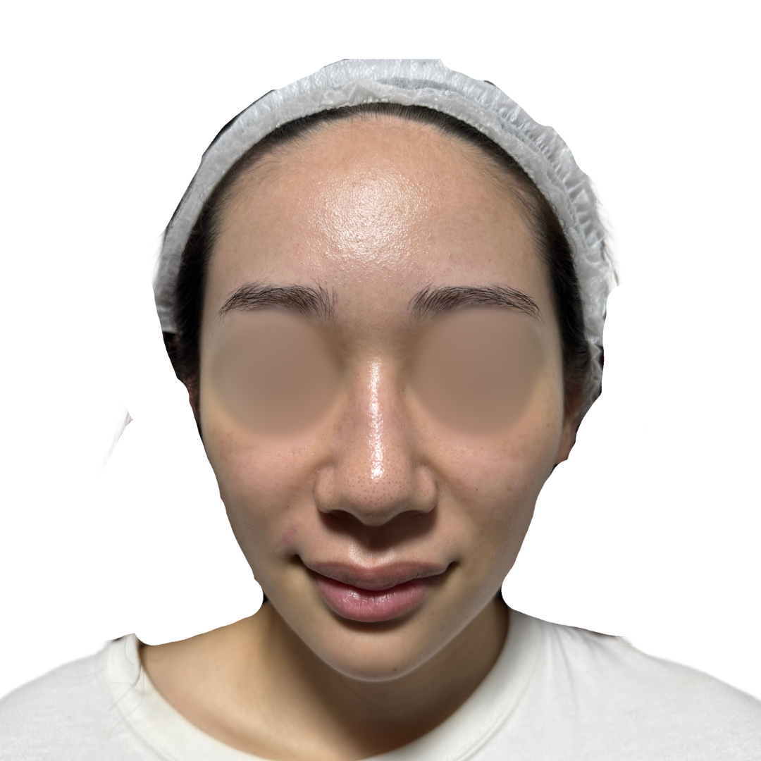 水光注射（スキンブースター）